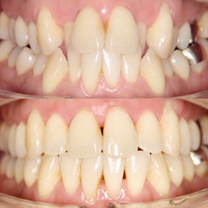 歯周病を予防する矯正治療