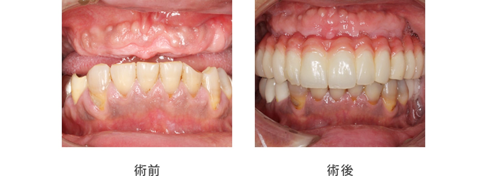 症例1. 他の歯科医院では固定性の歯で修復するのは困難と言われた症例